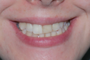 Invisalign Whitening and Bonding